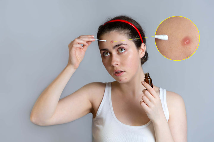 Can You Use Chaga to Fight Acne? - AlaskaChaga