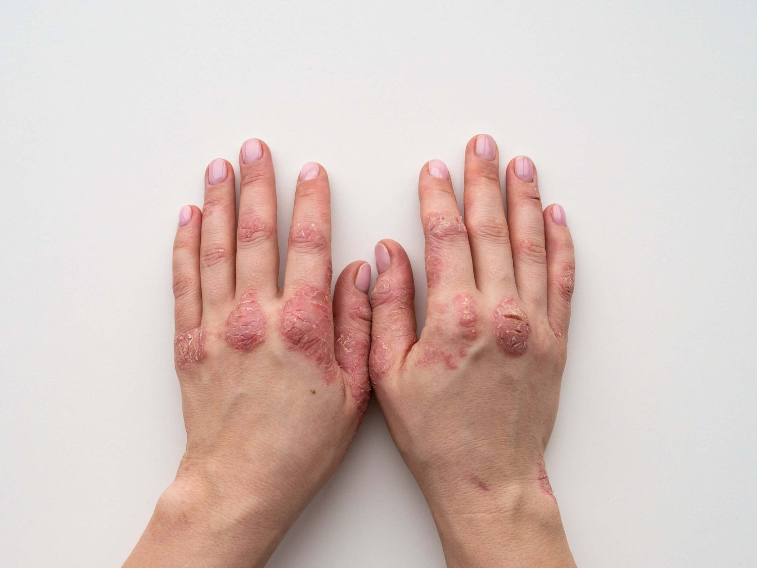 Chaga for Psoriasis: What the Research Actually Shows - AlaskaChaga