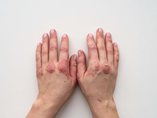 Chaga for Psoriasis: What the Research Actually Shows - AlaskaChaga