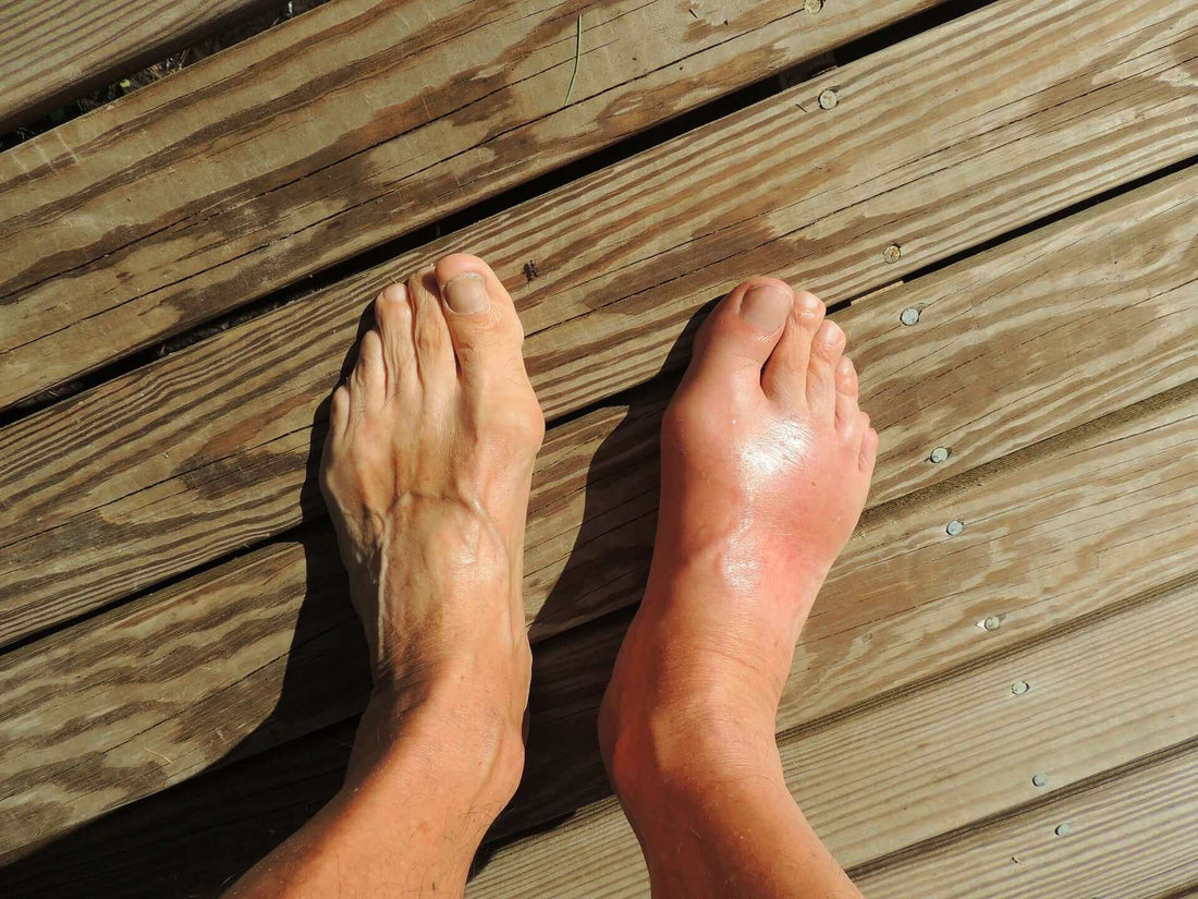 Treating gout with chaga tea - AlaskaChaga